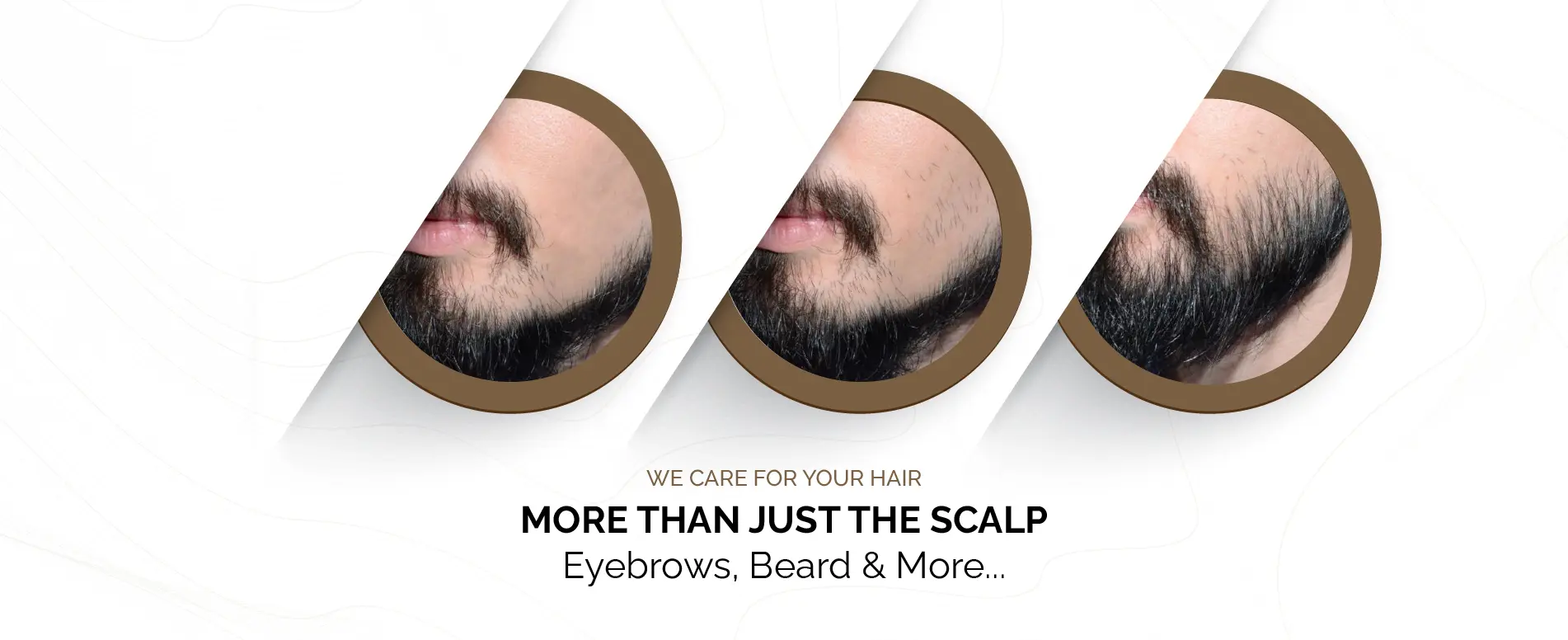 Direct Hair Transplant Direct Hair Transplant